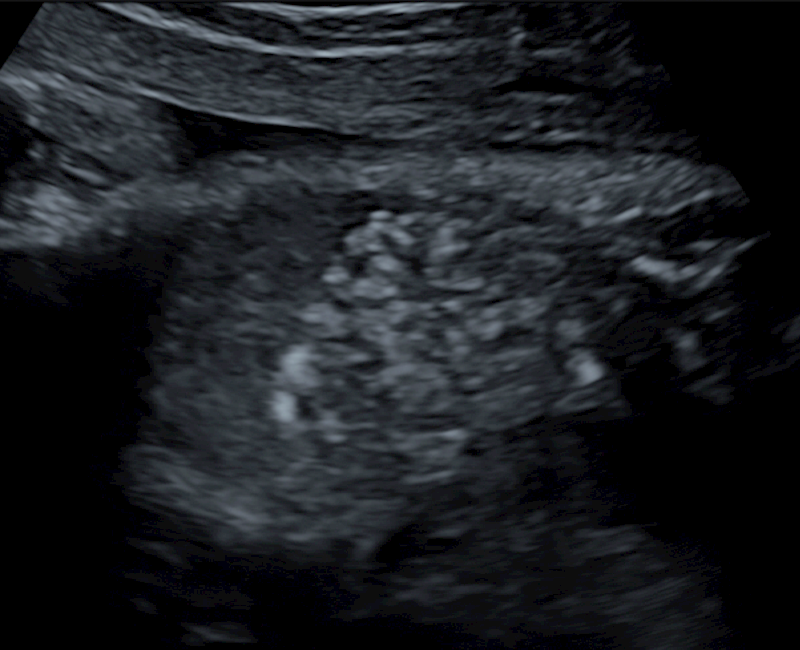 Fetal echogenic bowel: Is there a national consensus on ID and reporting?